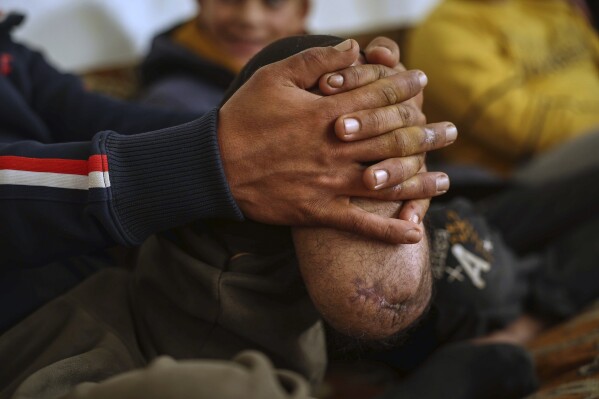 Shepherd Jalal Ma'rouf, 22, rests his hands on the stump of the limb he lost to a landmine while herding sheep in farmland recently recaptured from regime forces, at his home in Deir Sunbul village, south of Idlib, Wednesday, April 9, 2025. (AP Photo/Ghaith Alsayed)