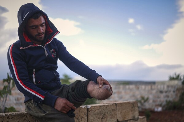 Shepherd Jalal Ma'rouf, 22, shows the stump of the limb he lost to a landmine while herding sheep in farmland recently recaptured from regime forces, at his home in Deir Sunbul village, south of Idlib, Wednesday, April 9, 2025. (AP Photo/Ghaith Alsayed)